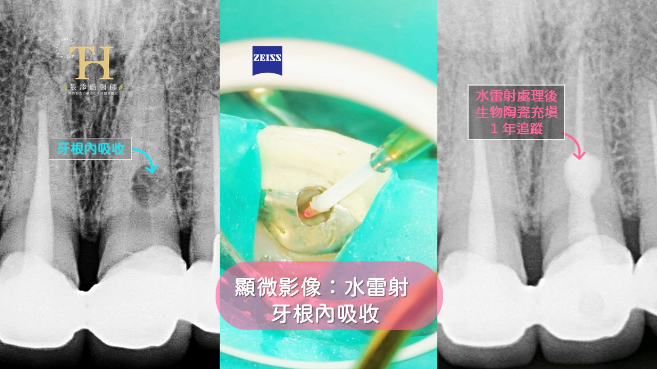 牙根外吸收、牙根內吸收，顯微根管治療˙張添皓醫師
