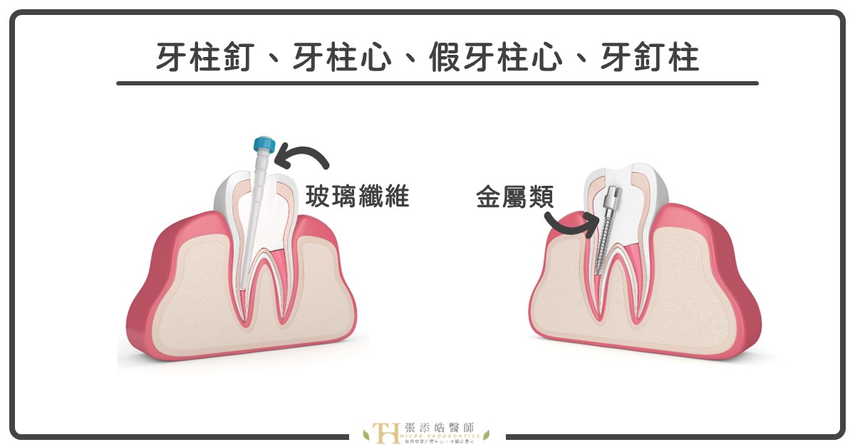 牙柱釘、牙釘柱，張添皓顯微根管治療