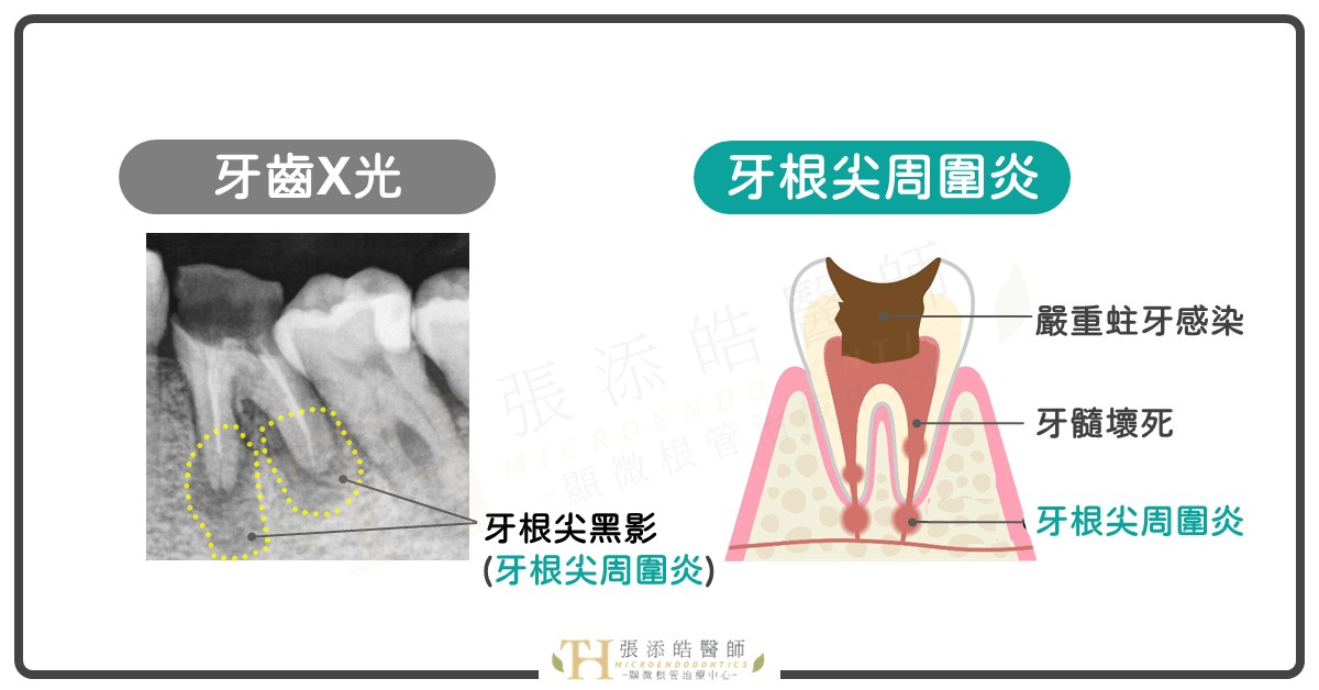 牙根尖周圍炎、牙根尖發炎