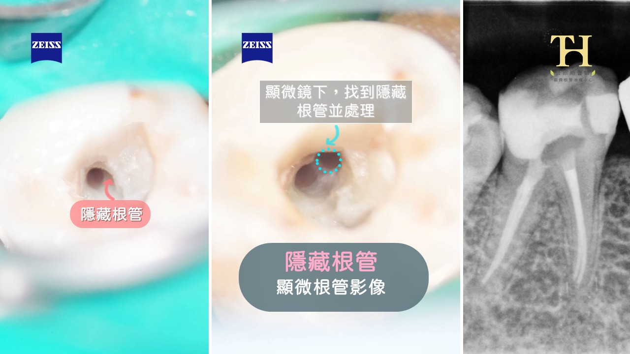 飛機上牙痛爆？氣壓性牙痛6點注意事項！空姐親身經歷揭密，可能需要顯微根管治療了