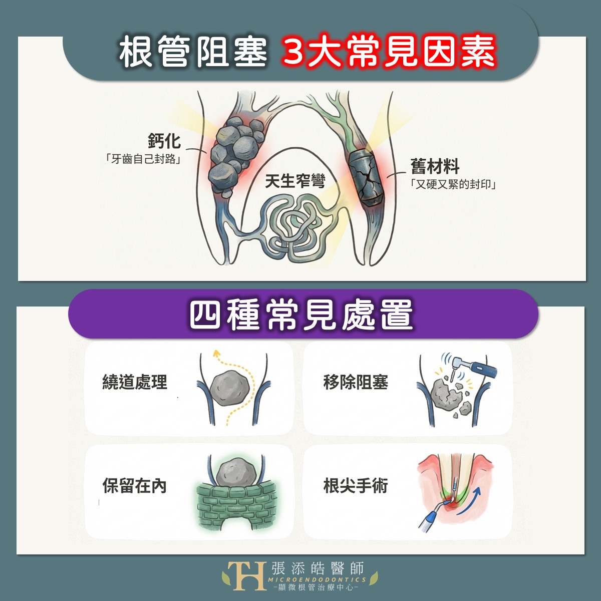 根管阻塞？根管治療後牙齦膿包不退？張添皓醫師顯微根管治療