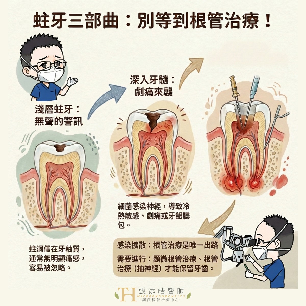 牙髓疾病的發展過程中，蛀牙通常會經歷以下 3 個階段