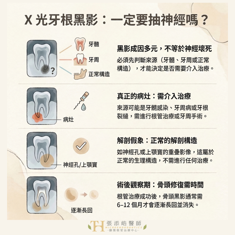 X光牙根黑影一定要抽神經嗎？顯微根管治療張添皓
