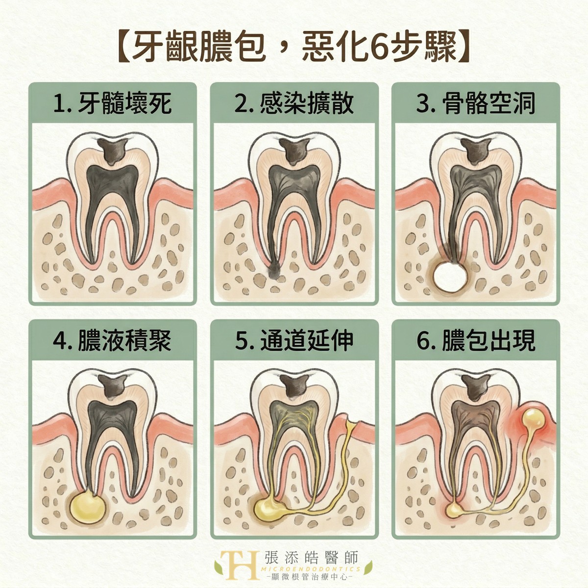 牙齦膿包惡化6個階段。顯微根管治療張添皓醫師