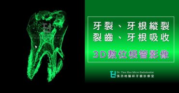 牙裂、牙根裂、裂齒、牙根吸收的3D數位根管影像