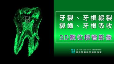 牙裂、牙根裂、裂齒、牙根吸收的3D數位根管影像