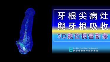 牙根尖病灶與牙根吸收的3D數位根管影像