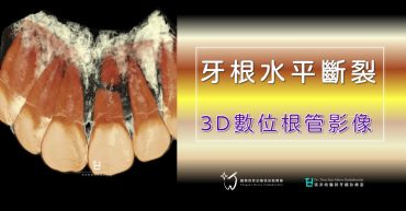 牙根水平斷裂，你擔心嗎？3D數位根管影像(14)