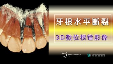 牙根水平斷裂，你擔心嗎？3D數位根管影像(14)