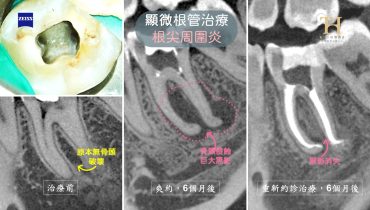 根尖周圍炎彎曲1