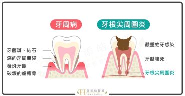 牙齦膿包、牙根尖黑影，是牙周病還是牙根尖發炎？寬02