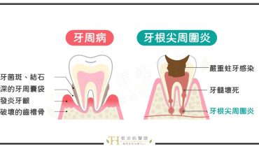 牙齦膿包、牙根尖黑影，是牙周病還是牙根尖發炎？寬02
