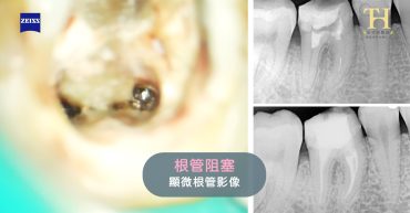根管阻塞2