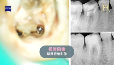 根管阻塞2